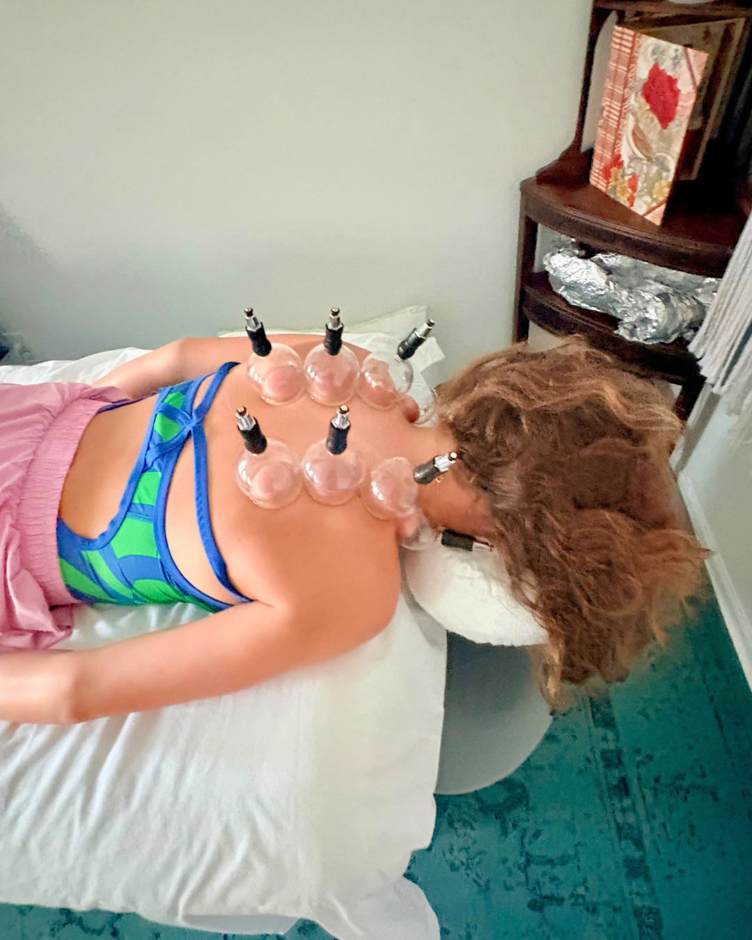 Acupuncture and cupping carousel image 5